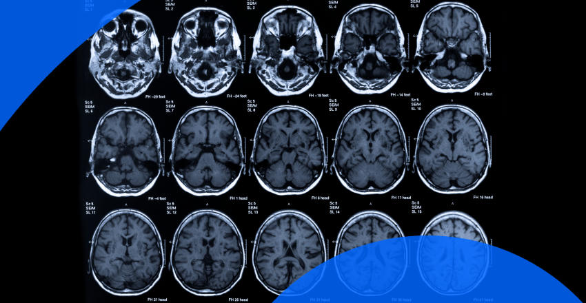 Brain MRI – American Brain Foundation